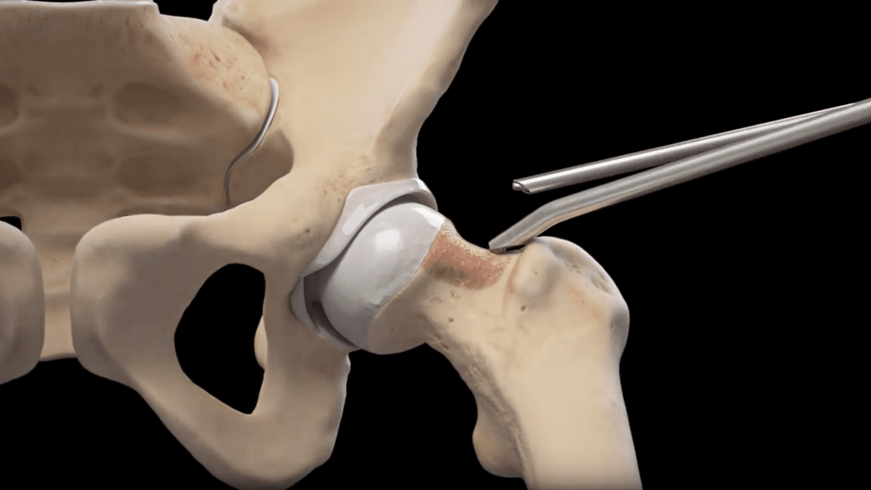 Arthrex Hip Software cover image